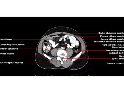 Ct Of The Abdomen Axial Anatomy Radiologypicscom Pelvis Anatomy