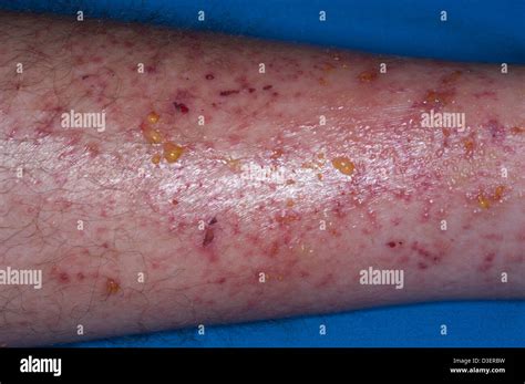 Poison Ivy Dermatis Rash On Leg Stock Photo Alamy