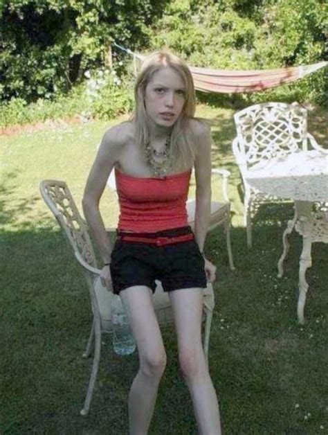 30 Shocking Pics Of Anorexic Girls Klykercom