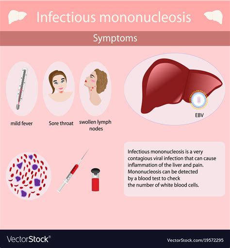 Symptoms Of Infectious Mononucleosis Royalty Free Vector