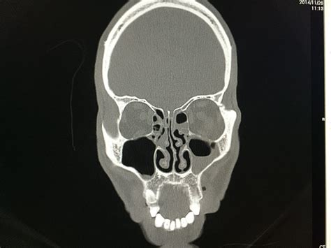 Ct Scan Of Throat And Neck Ct Scan Machine