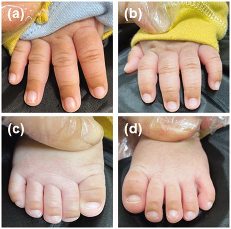 Transient Neonatal Hyperpigmentation Of The Proximal Nail Fold In A