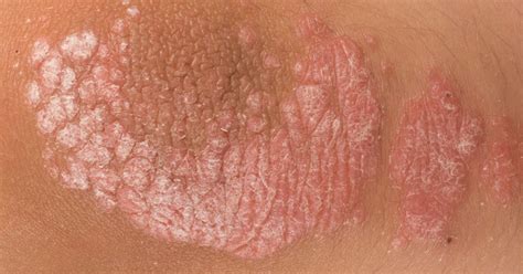 Psoriasis What Are The Signs And Symptoms