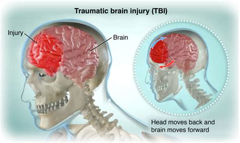 Traumatic Brain Injury Create Webquest