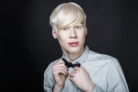 Albinizm Czym Jest Przyczyny Objawy I Leczenie Poradyfit Porn Sex Picture