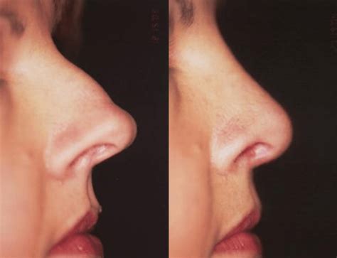 But i pay 7 dollars for a front aliment and 9 for a back, so my baseline is different. How Much Does a Nose Job Cost? | Winter Park Rhinoplasty ...