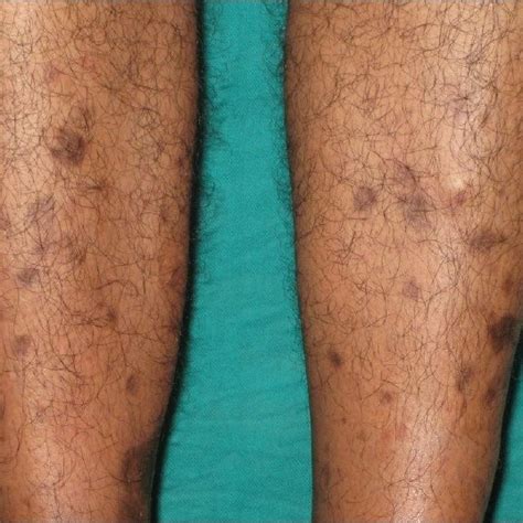 Multiple Well Defined Hyperpigmented Atrophic Macules Over Bilateral