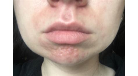 Help With Cystic Acne Bumps Hypertrophic Raised Scars By