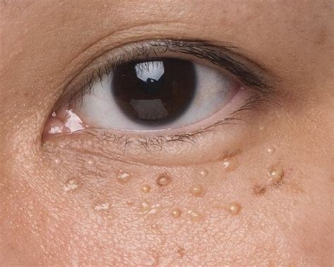 What Causes Milia On Face How To Remove And Treat
