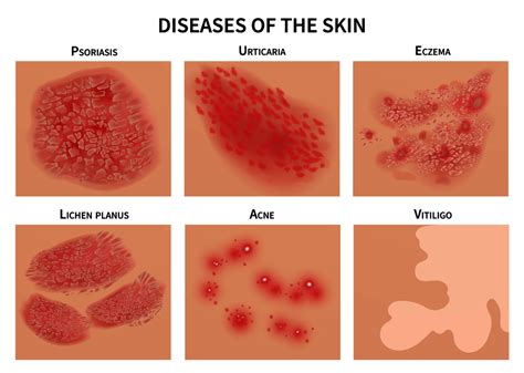 Eczema As Related To Dermatology Pictures