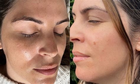 Facial Chemical Peel Revive Aesthetics By Chloe Groupon