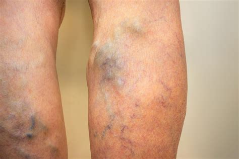 Can Varicose Veins Increase Risk Of Blood Clot Scimex