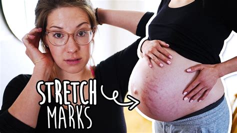 Why Am I Getting Stretch Marks This Pregnancy Youtube