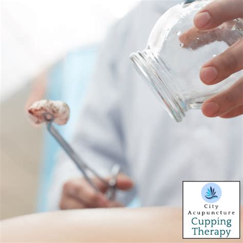 Cupping Therapy Adelaide Fire Cupping Wet Cupping Hijama Detox
