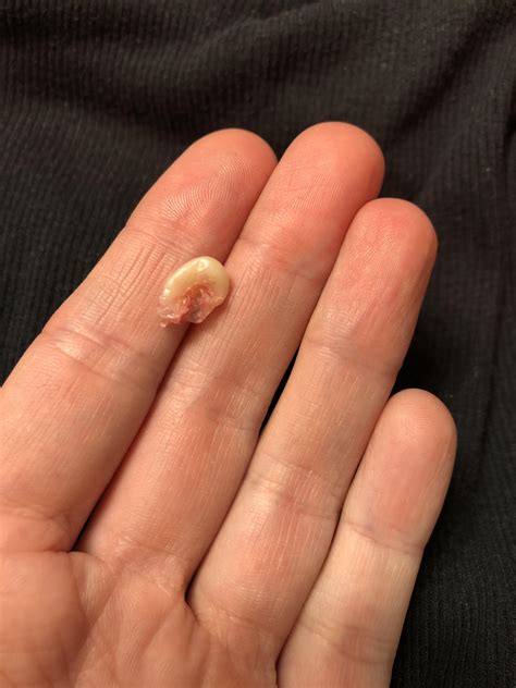 Sebaceous Cyst Just Pulled This Out Of My Head With Tweezers Made A