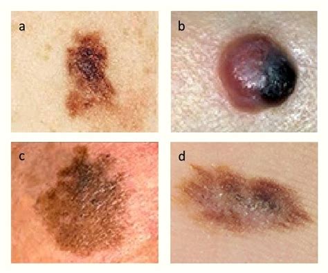 Skin Cancer Black Mole