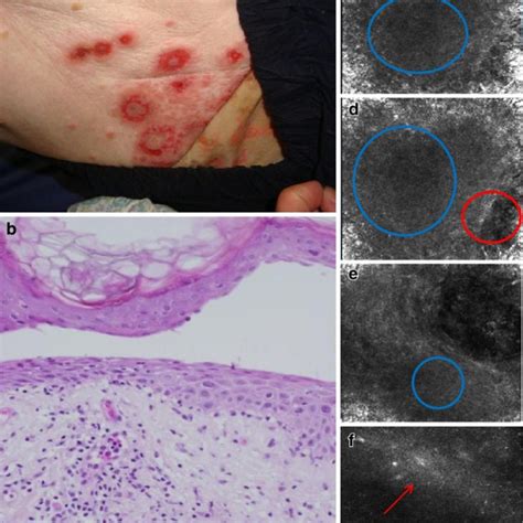 Bullous Pemphigoid A Tense Blisters Confocal Microscope Probe Is Seen