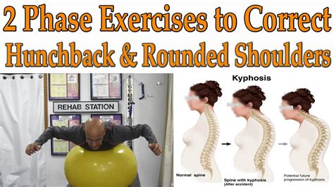 Phase Exercises To Correct Hunchback Kyphosis Rounded Shoulders Dr Mandell Youtube