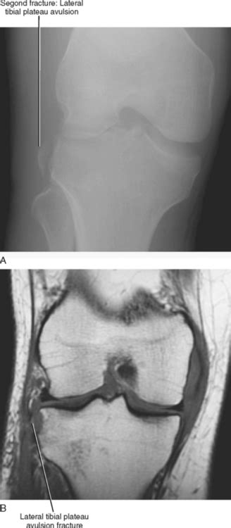IMAGING OF THE KNEE | Radiology Key