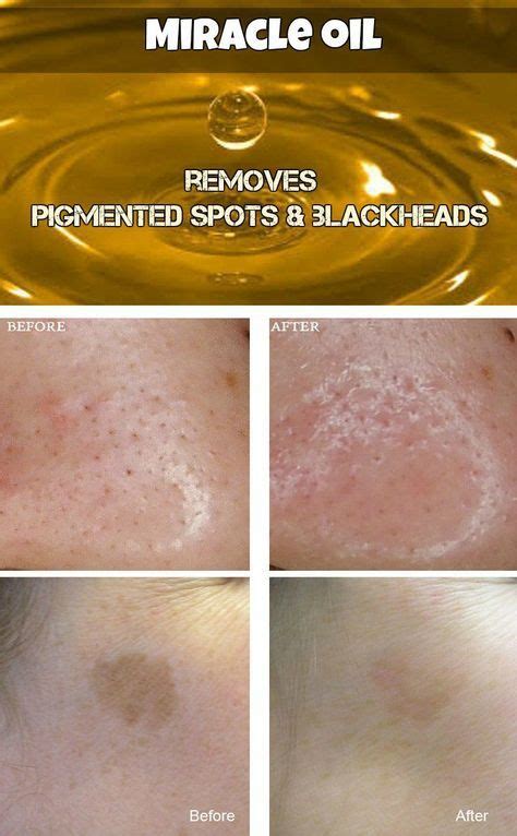 Miracle Oil That Removes Pigmented Spots Blackheads And Beautifies