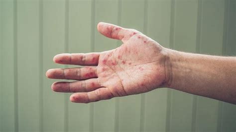 Fast Facts About Hand Foot And Mouth Disease Cs Mott Childrens