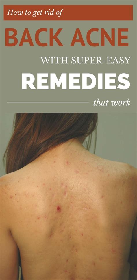 How To Get Rid Of Back Acne With Super Easy Remedies That Work Acne