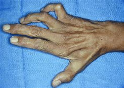 Figure4 Ulnar Clawing With Hyperextension Of The Metacarpal Phalangeal