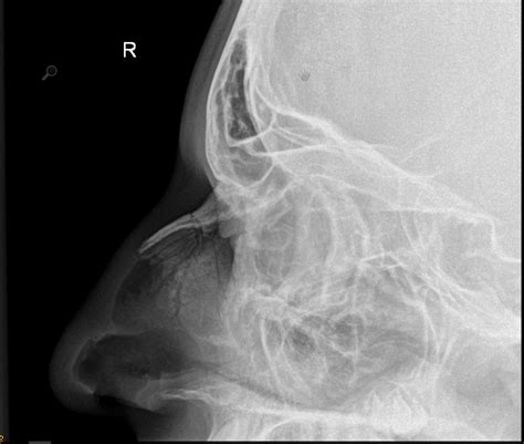 X Ray Nasal Bone Fracture After Stockfoto 1068960836