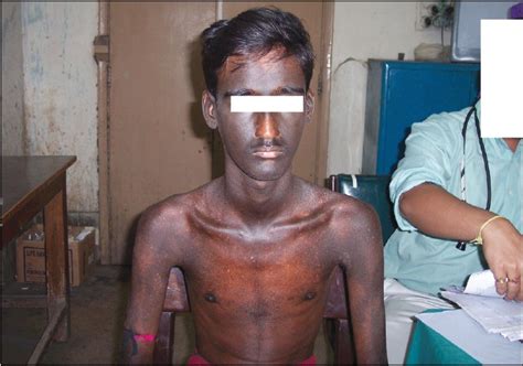 Ashy Dermatosis A Controversial Entity Chakrabarti N Chattopadhyay C