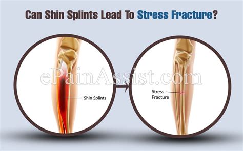 Can Shin Splints Lead To Stress Fracture