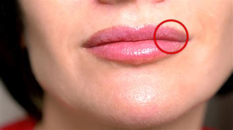 Masz Białe Krostki Na Ustach I Częściach Intymnych Lekarz Mówi Czy To Powód Do Zmartwień