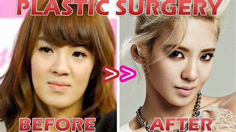V Plastic Surgeon Bts Plastic Surgery Before And After