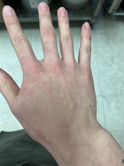 Hand Rashwelts Rdermatologyquestions