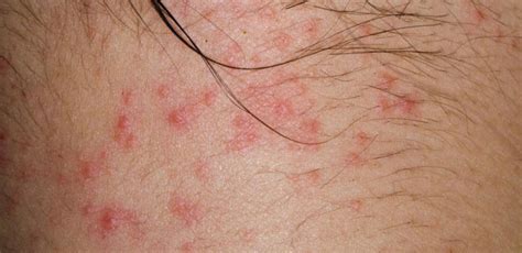 Curious About Atopic Dermatitis Heres What You Need To Know All Answers