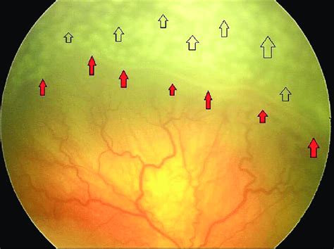 Fundus Image Taken Immediately After Indirect Retinal Laser