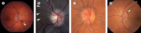 Optic Neuritis And Autoimmune Optic Neuropathies Advances In Diagnosis