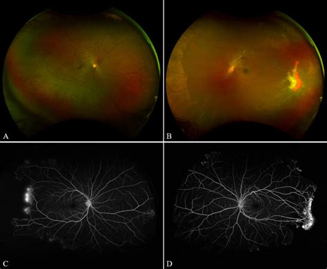 Nonmydriatic Ultra Widefield Fundus Photography In A Hematology Clinic