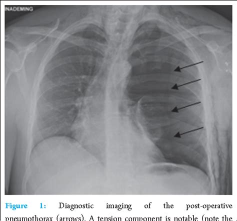 Figure 1 From Pneumothorax After Shoulder Arthroscopy A Rare But Life