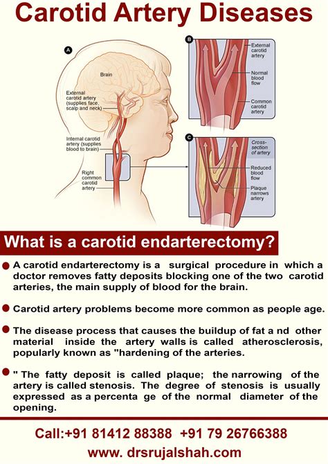 Carotid Endarterectomy Is A Surgical Procedure Used To Reduce The Risk Of Stroke By Correcting