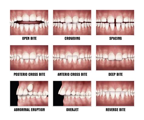 Malocclusion Signs Causes And Impacts Nha Khoa Numberone