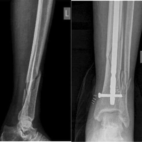 Pre And Post Operative X Rays Of Distal Tibia Fracture Treated With