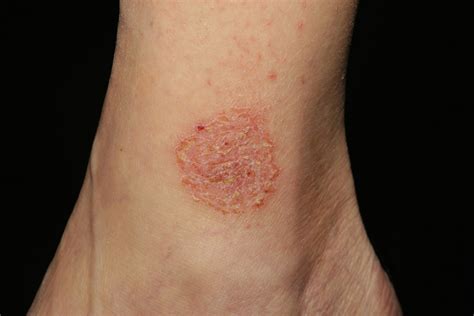 Nummular Dermatitis Symptoms Pictures And Treatment Healthdiseasesorg