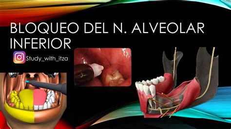 Bloqueo Del Nervio Alveolar Inferior Udocz
