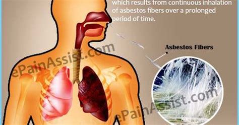 The Term That Describes The Lung Disease Caused By Asbestos
