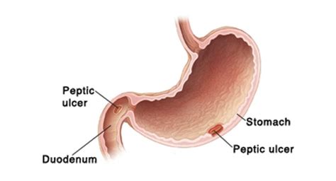 Best Hospital For Peptic Ulcer Surgery Smiles Gastroenterology