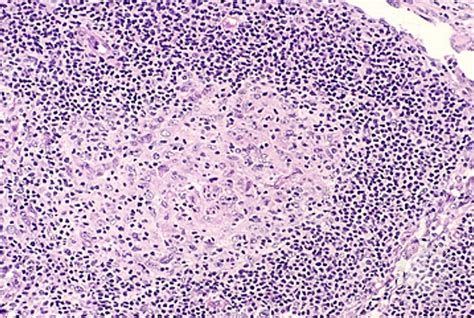 The prognosis is generally poor. Angioimmunoblastic T Cell Lymphoma - 11.