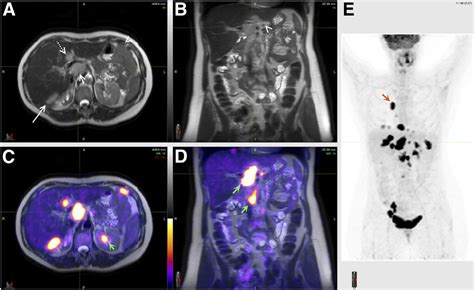 Molecular Imaging Of Ovarian Cancer Journal Of Nuclear Medicine