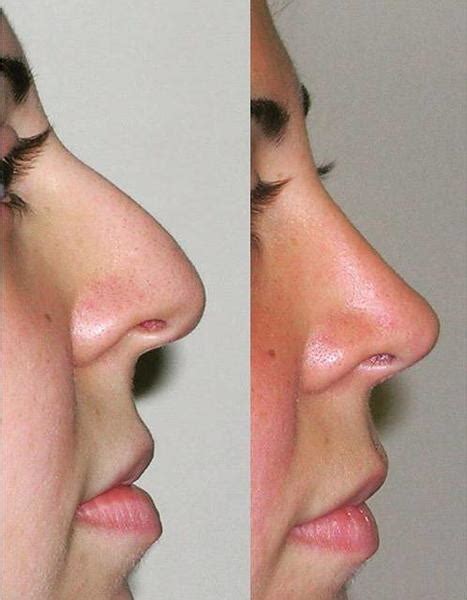 Septoplasty Photo Before And After 3 Rhinoplasty Cost Pics