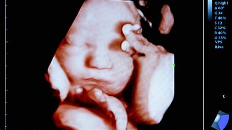 4d Ultrasound What It Is And When To Do It