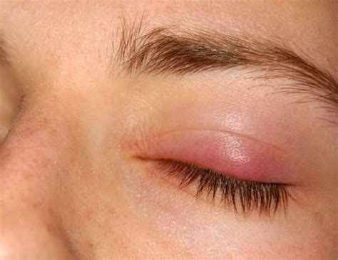 What Causes Swollen Upper Eyelid Artofit